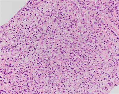 Case report: Robotically visualized and biopsy-confirmed peritoneal carcinomatosis as initial identification of metastatic prostate adenocarcinoma in a patient with a history of prostatic urethral lift